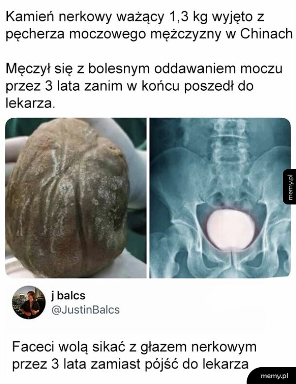 Zdjęcie wielkiego kamienia nerkowego oraz zdjęcie RTG miednicy z gigantycznym kamieniem.